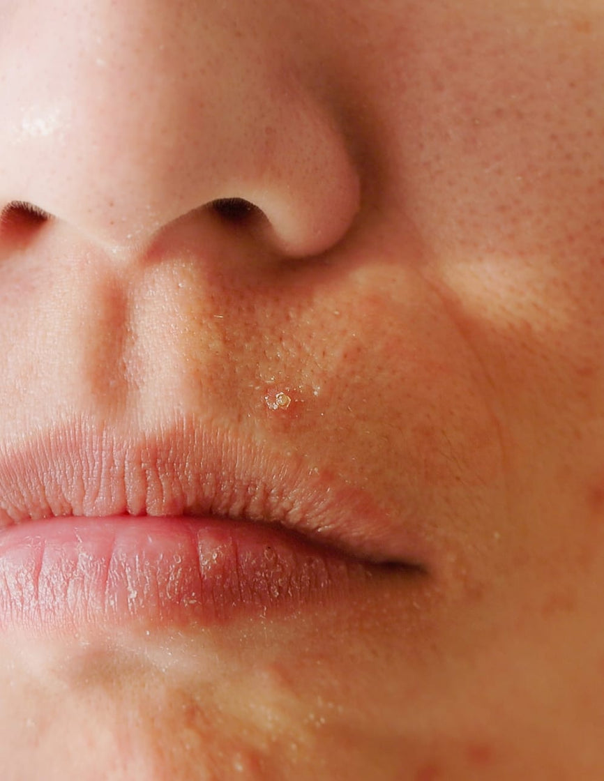 Understanding Acne: MOSAIK’s Dermatological Approach